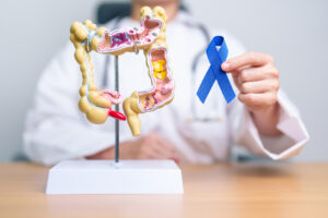 Oncologist with model depicting colon cancer
